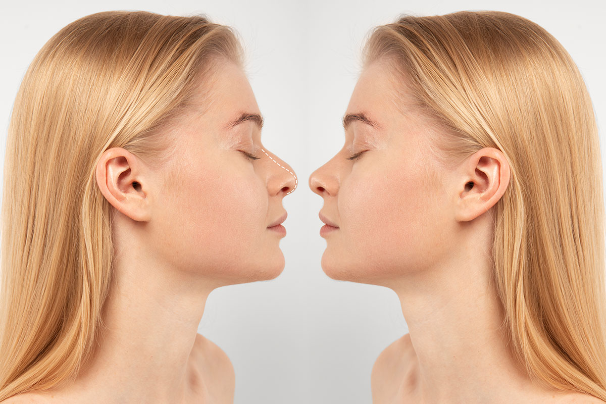 Malatya Burun Estetiği