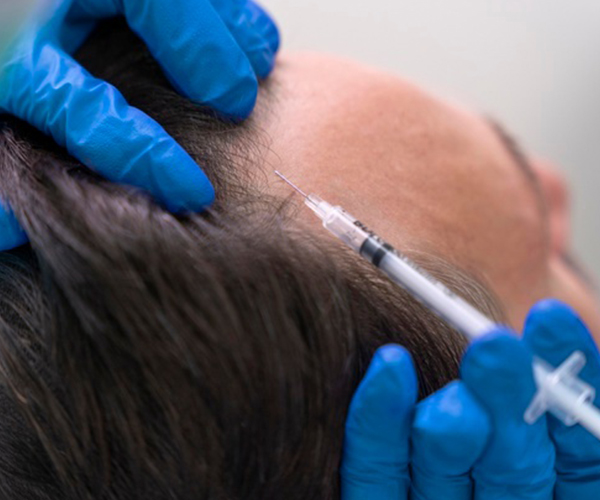 Saç Mezoterapisi